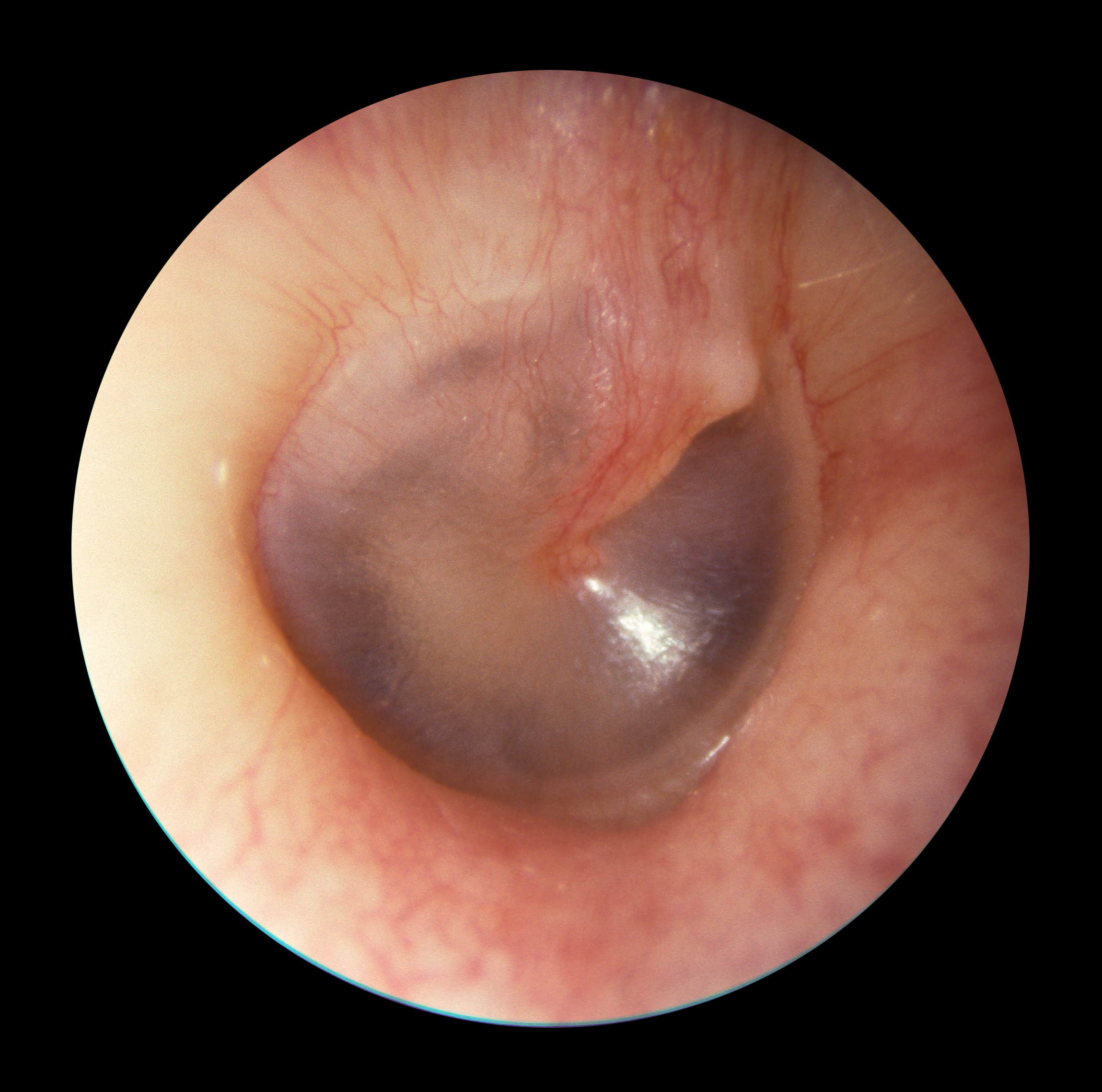 Normal right tympanic membrane viewed through an otoscope showing a translucent membrane, visible malleus handle, umbo, and cone of light.